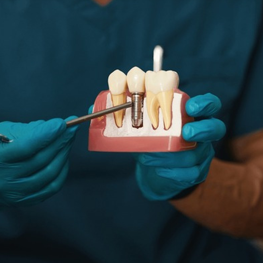 Implantes